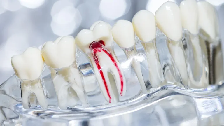 Como saber se o dente precisa de canal